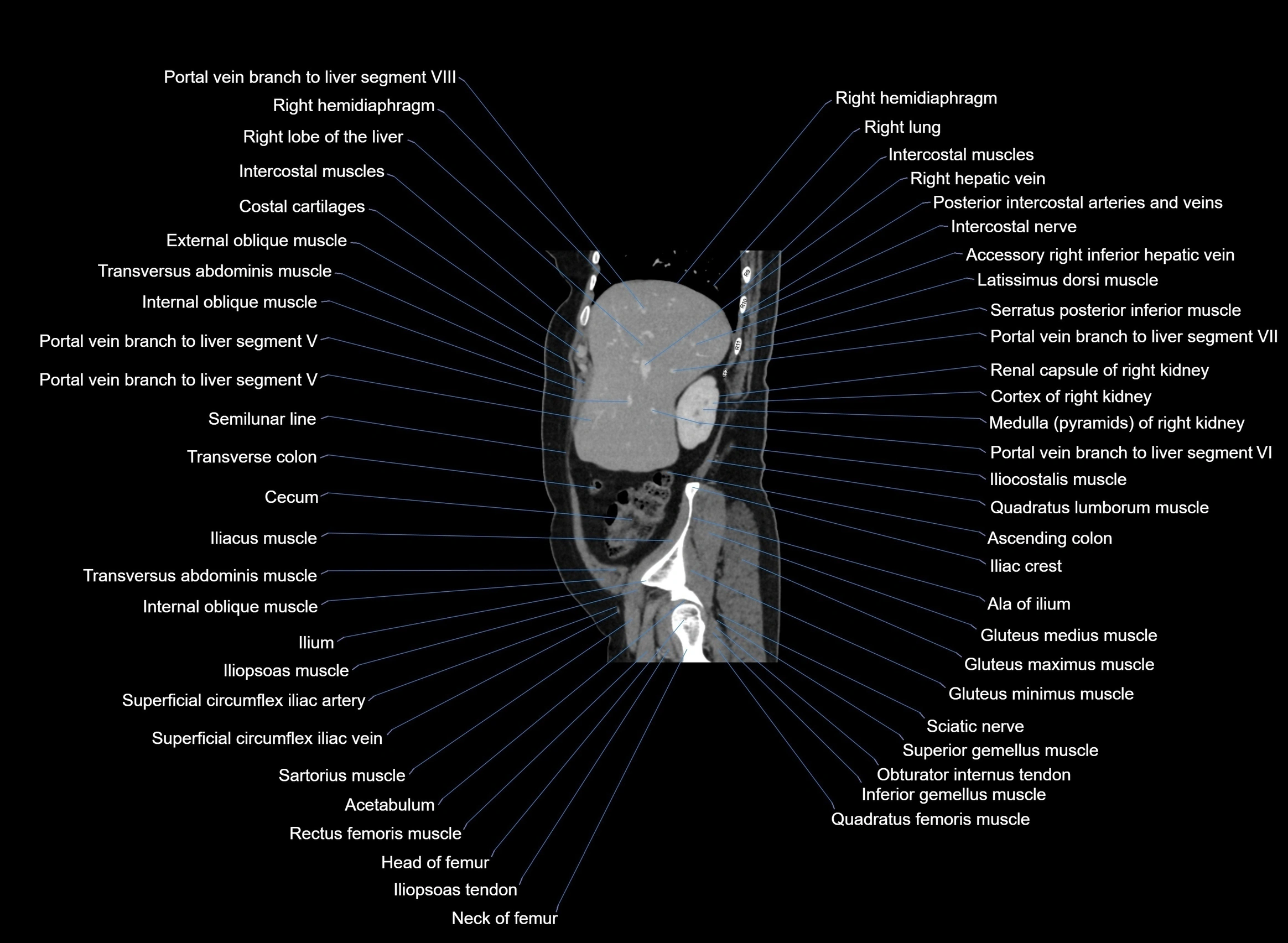 CT Abdomen sagittal cross sectional anatomy labelled radiology image -00089.webp